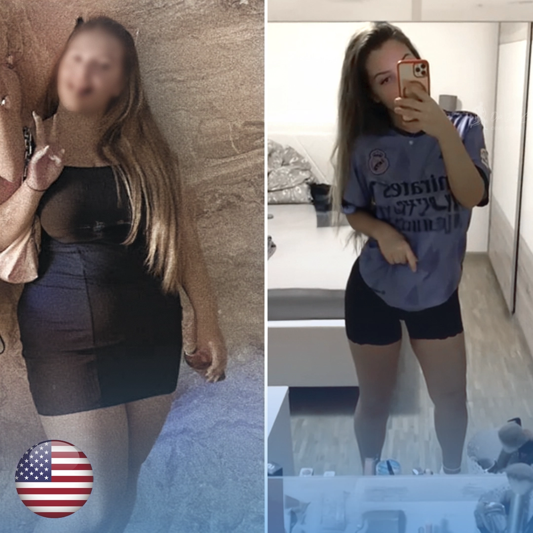 weight loss surgery before after photo